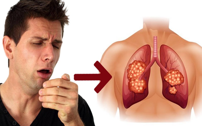 Dấu hiệu ung thư phổi: Ho dai dẳng kéo dài